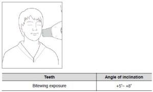 بایتوینگ 300x181 - رادیوگرافی تک دندان و روش انجام آن